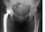 Protesi d’anca a rischio di frattura