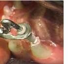 Mastociti e impianti endodontici