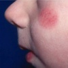 Aliamidi nella dermatite atopica del bambino