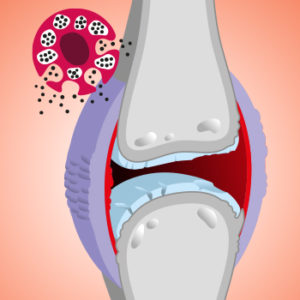 Il profondo legame tra mastociti e osteoartrite