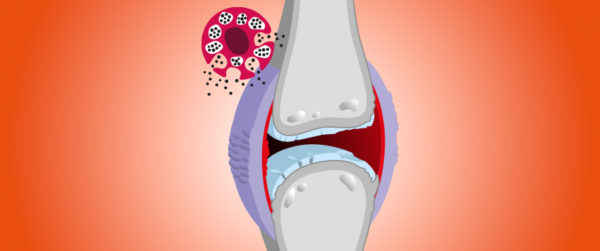 Il profondo legame tra mastociti e osteoartrite