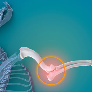 La chirurgia non arresta l’osteoartrite di gomito