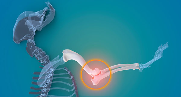 La chirurgia non arresta l’osteoartrite di gomito